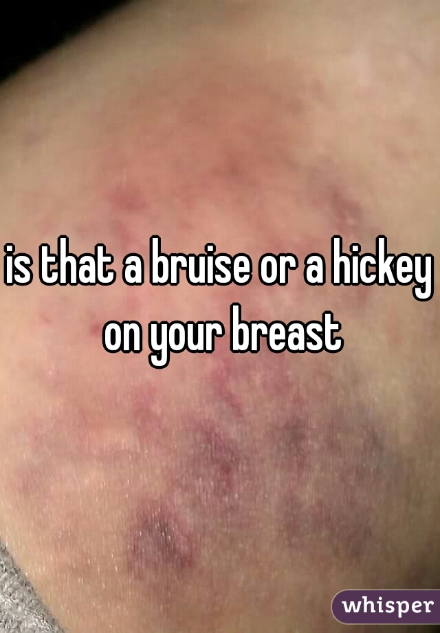 Red spot on breast looks like hickey