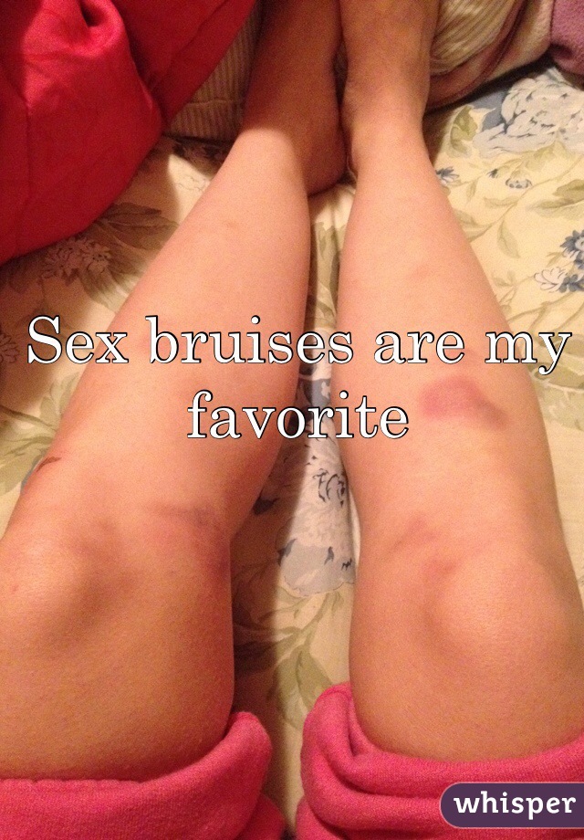Legs sex bruises on Leg Bruise