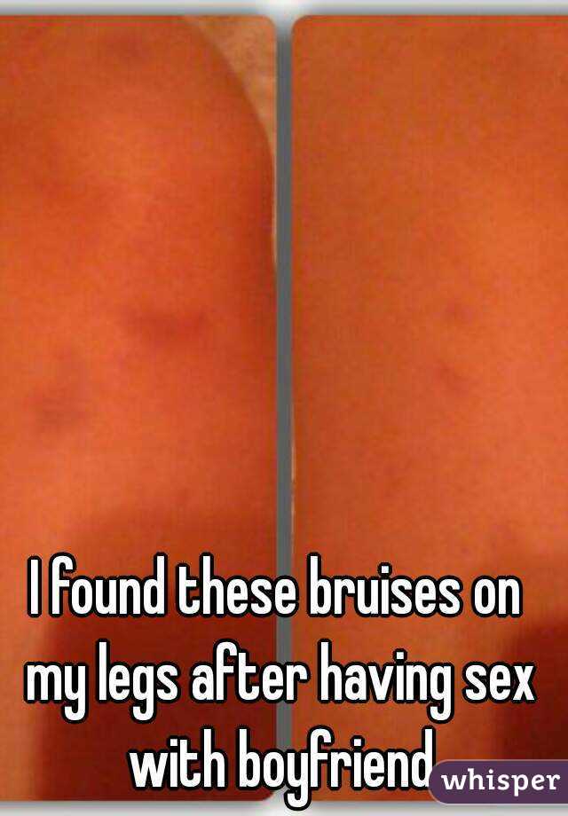 Sex bruises on legs