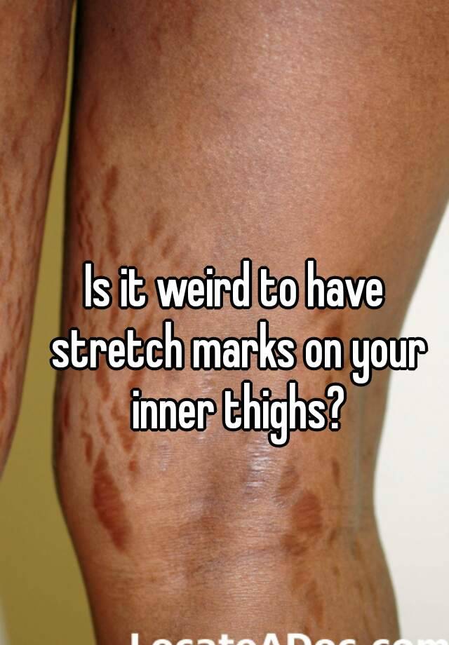 is-it-weird-to-have-stretch-marks-on-your-inner-thighs