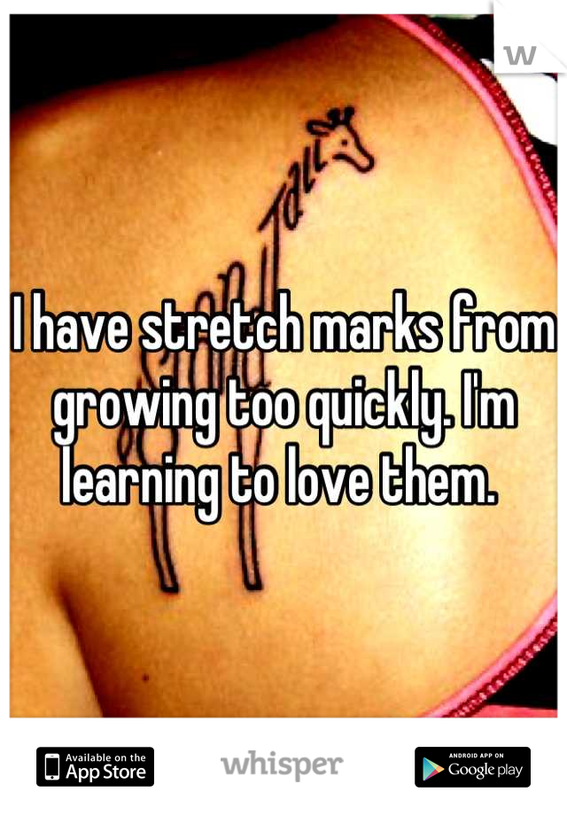 I have stretch marks from growing too quickly. I'm learning to love them. 