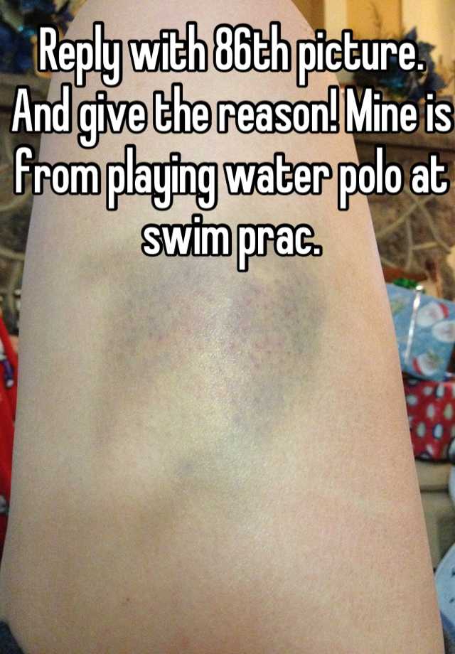 Reply with 86th picture. And give the reason! Mine is from playing water polo at swim prac.