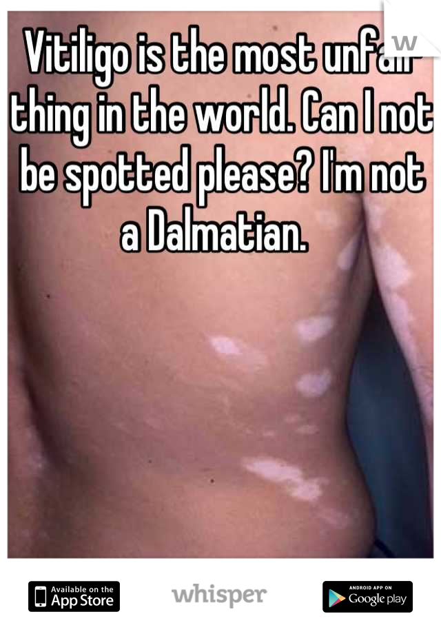Vitiligo is the most unfair thing in the world. Can I not be spotted please? I'm not a Dalmatian.  