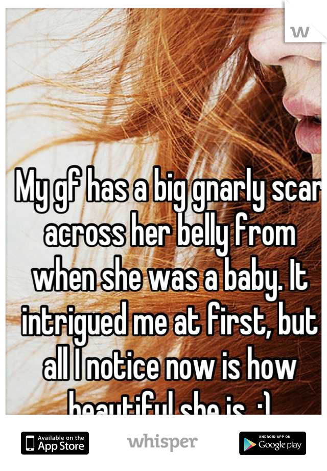 My gf has a big gnarly scar across her belly from when she was a baby. It intrigued me at first, but all I notice now is how beautiful she is. :)