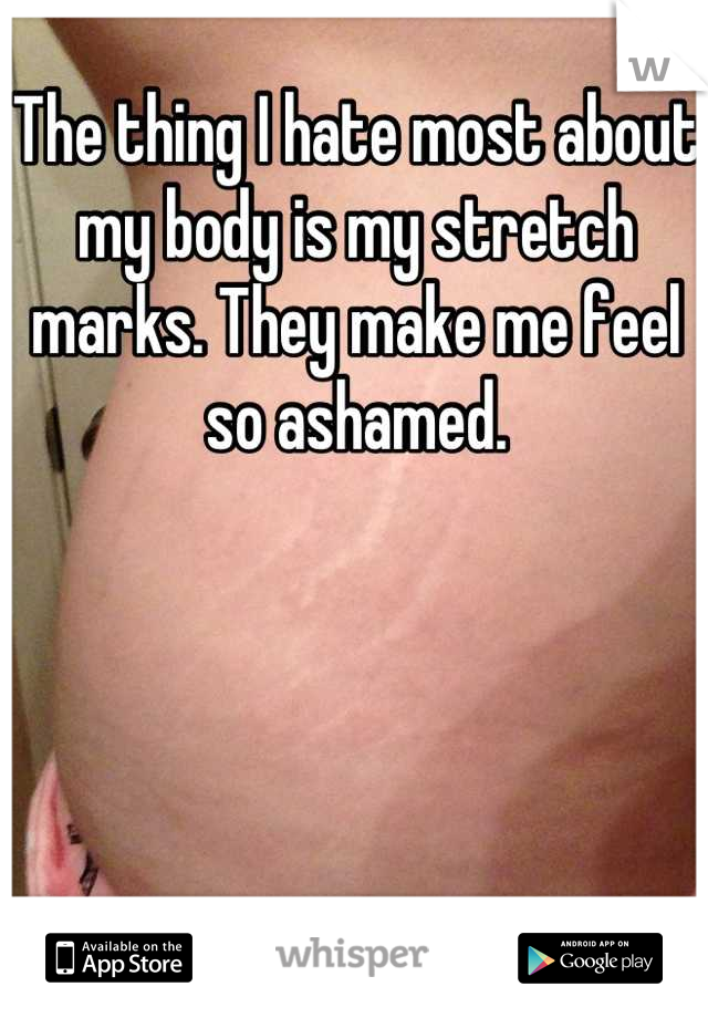 The thing I hate most about my body is my stretch marks. They make me feel so ashamed.