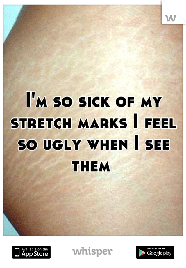 I'm so sick of my stretch marks I feel so ugly when I see them 