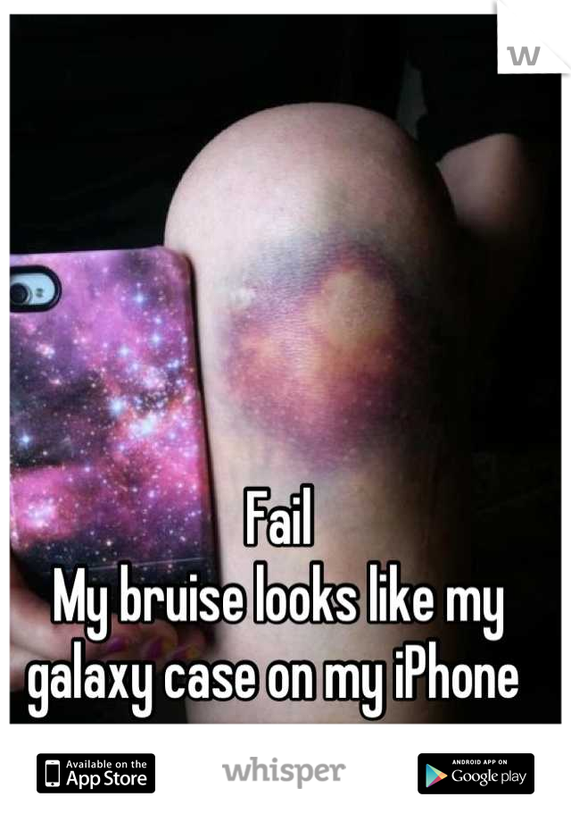 Fail
My bruise looks like my galaxy case on my iPhone 