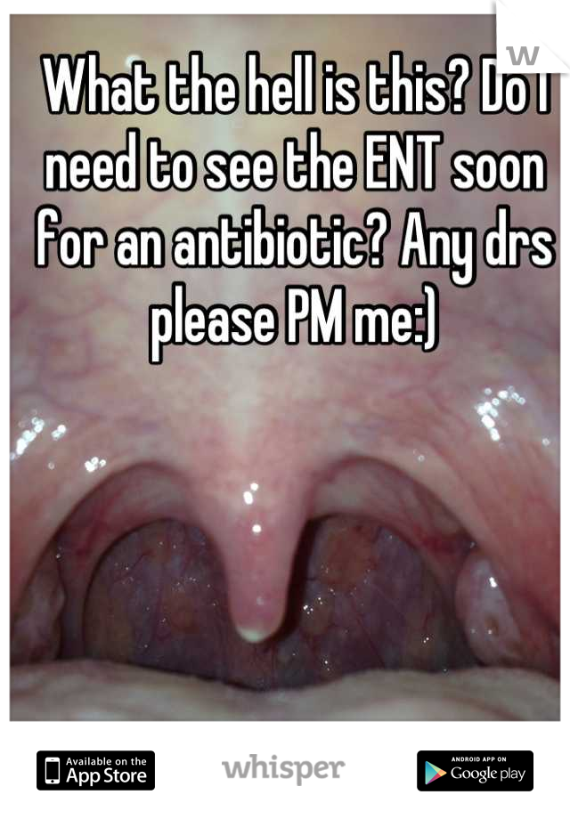 What the hell is this? Do I need to see the ENT soon for an antibiotic? Any drs please PM me:)