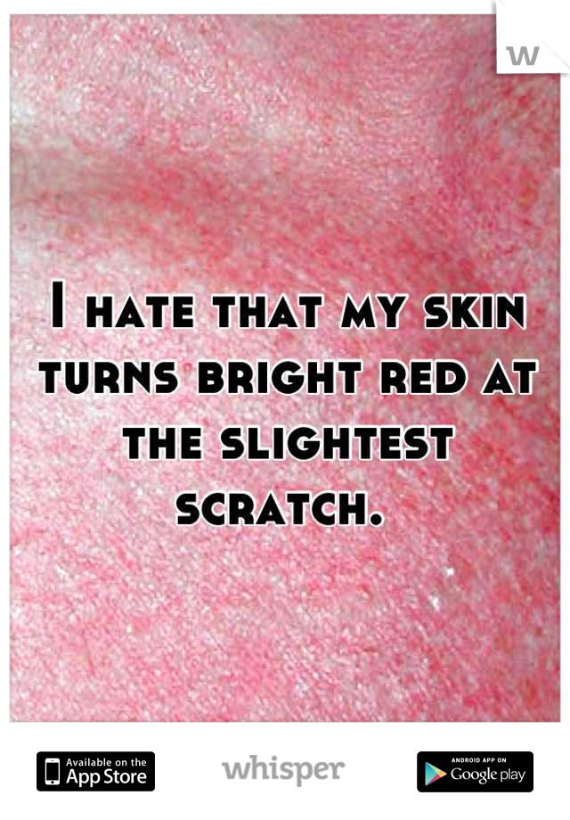 I hate that my skin turns bright red at the slightest scratch. 