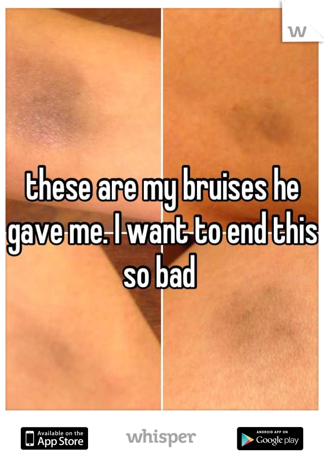these are my bruises he gave me. I want to end this so bad 