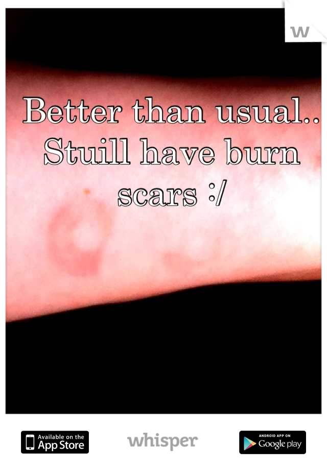 Better than usual.. Stuill have burn scars :/