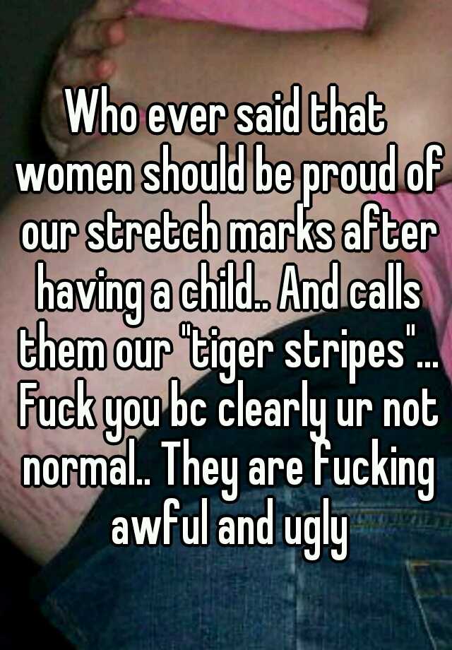 Who ever said that women should be proud of our stretch marks after having a child.. And calls them our "tiger stripes"... Fuck you bc clearly ur not normal.. They are fucking awful and ugly