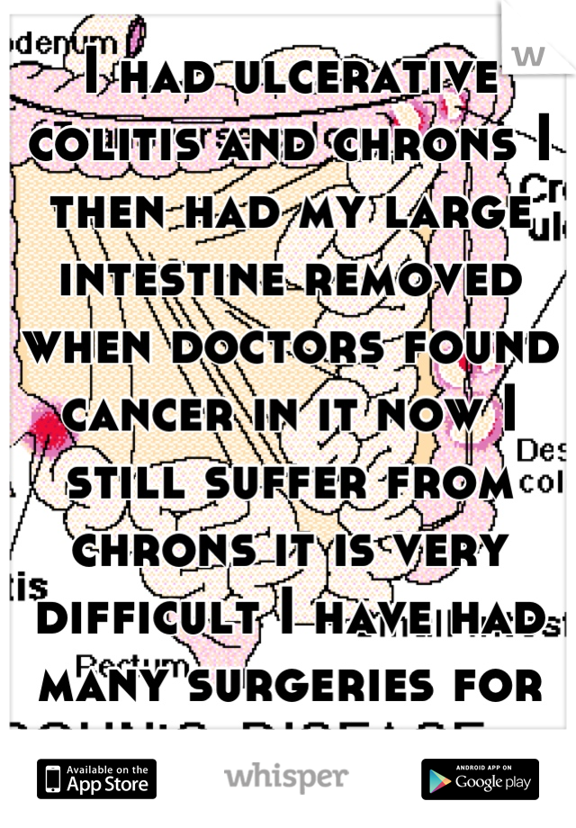 I had ulcerative colitis and chrons I then had my large intestine removed when doctors found cancer in it now I still suffer from chrons it is very difficult I have had many surgeries for other probs.
