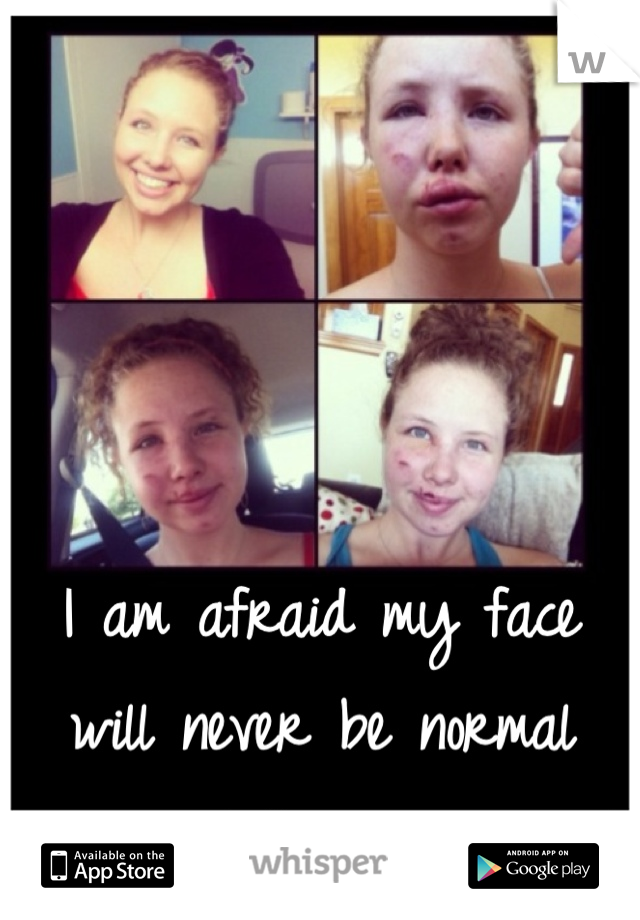 I am afraid my face will never be normal again... I feel so ugly :'(