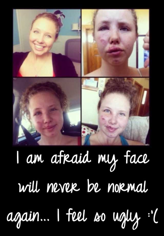 I am afraid my face will never be normal again... I feel so ugly :'(