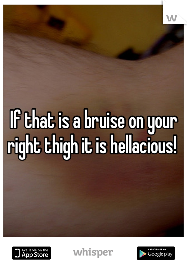 If that is a bruise on your right thigh it is hellacious! 