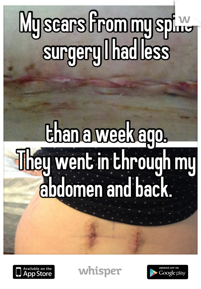 My scars from my spine surgery I had less 


than a week ago.
They went in through my abdomen and back.