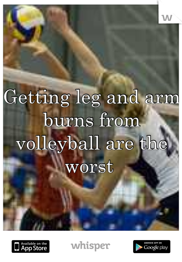 Getting leg and arm burns from volleyball are the worst 