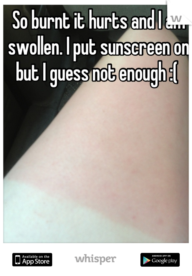 So burnt it hurts and I am swollen. I put sunscreen on but I guess not enough :( 