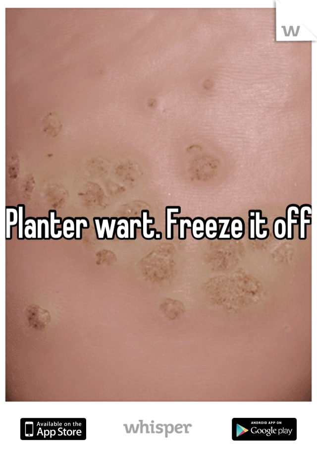 Planter wart. Freeze it off