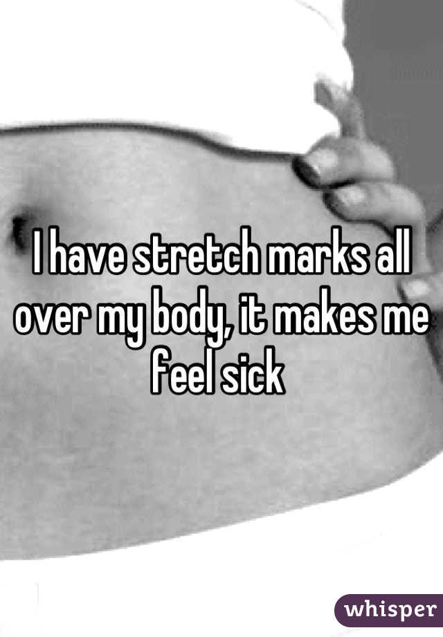 I have stretch marks all over my body, it makes me feel sick 