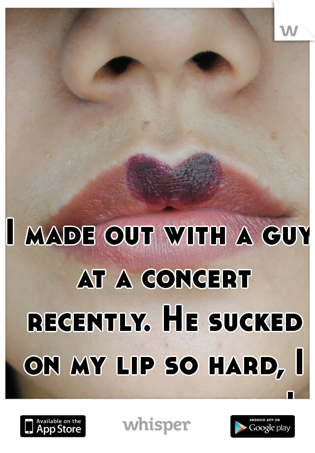 I made out with a guy at a concert recently. He sucked on my lip so hard, I have a bruise now!