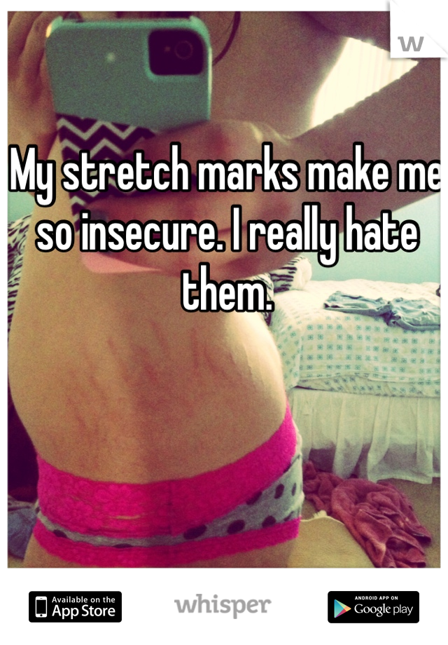 My stretch marks make me so insecure. I really hate them.
