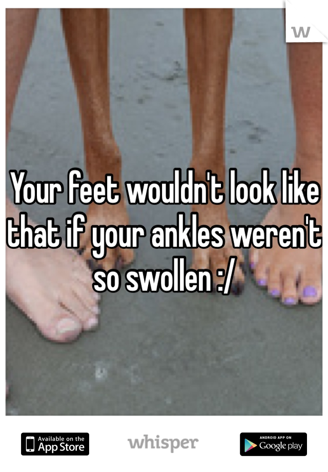 Your feet wouldn't look like that if your ankles weren't so swollen :/ 