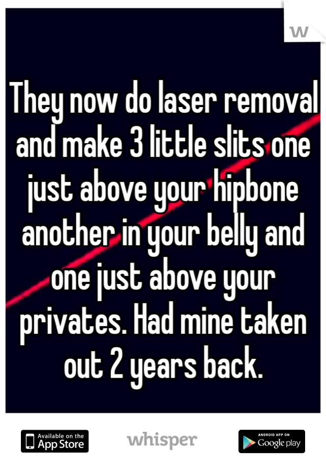 They now do laser removal and make 3 little slits one just above your hipbone another in your belly and one just above your privates. Had mine taken out 2 years back. 