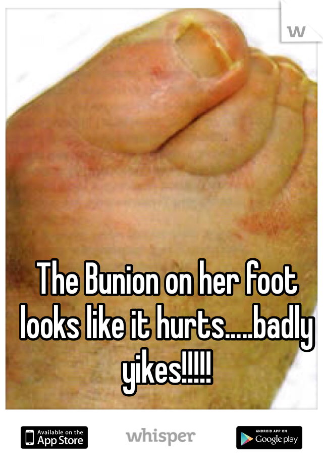 The Bunion on her foot looks like it hurts.....badly yikes!!!!! 