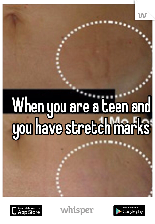 When you are a teen and you have stretch marks