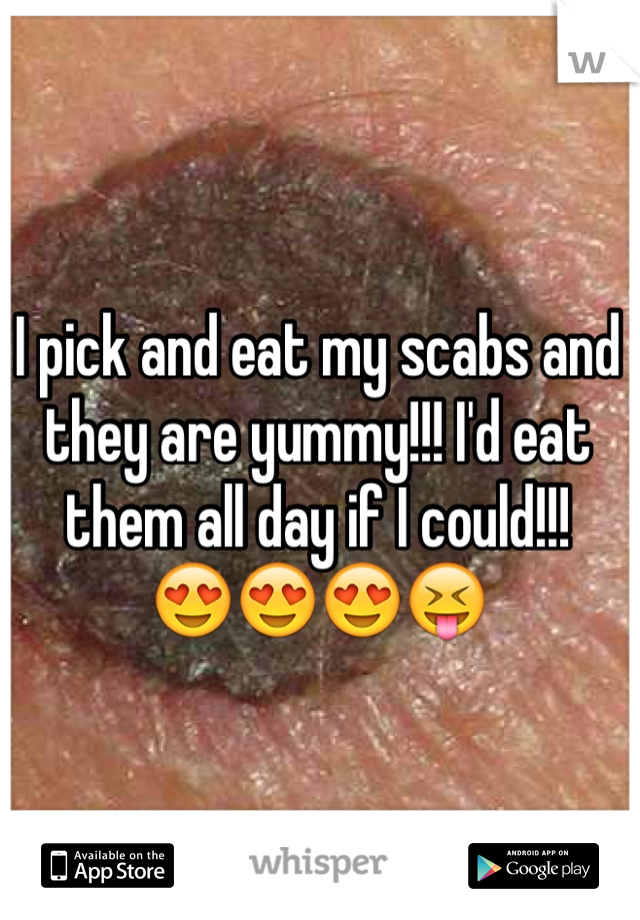 I pick and eat my scabs and they are yummy!!! I'd eat them all day if I could!!! 
😍😍😍😝
