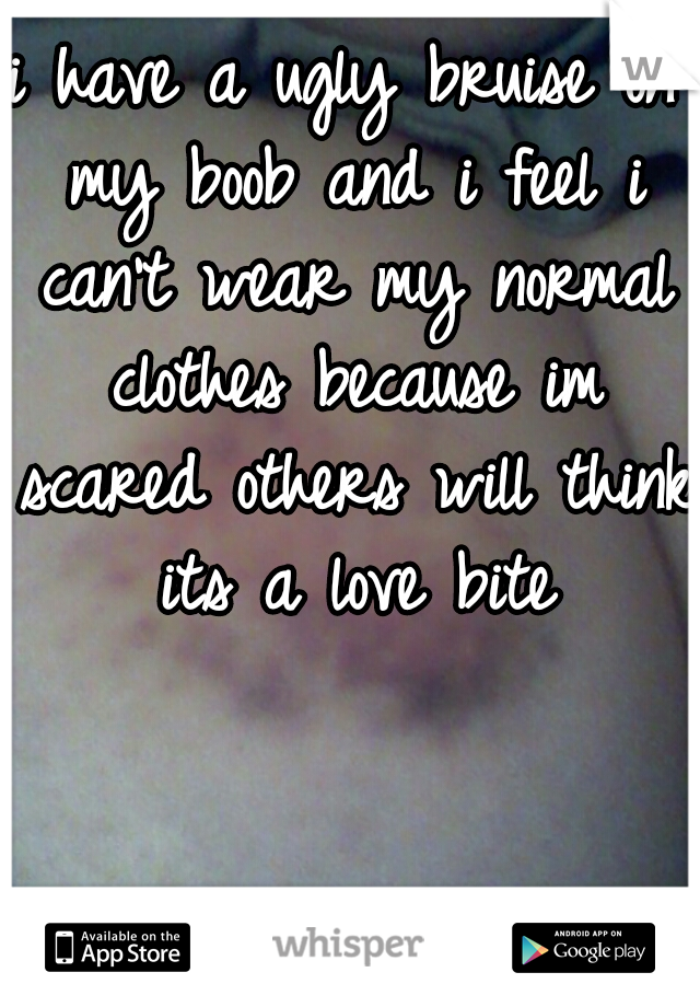 i have a ugly bruise on my boob and i feel i can't wear my normal clothes because im scared others will think its a love bite