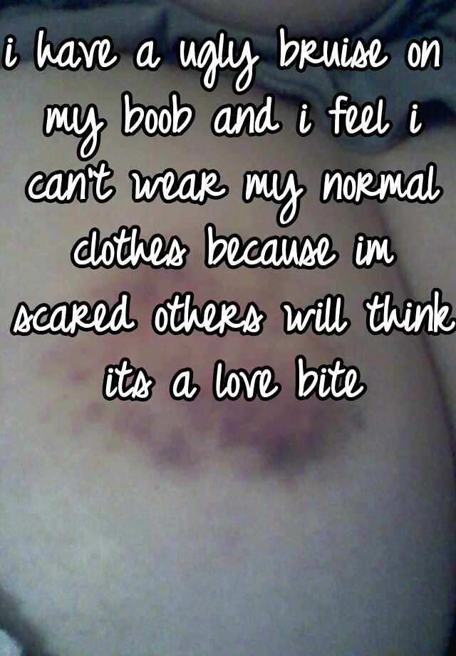 i have a ugly bruise on my boob and i feel i can't wear my normal clothes because im scared others will think its a love bite