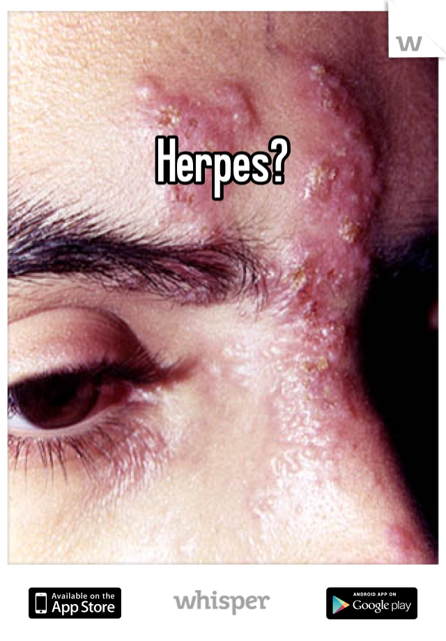 Herpes?