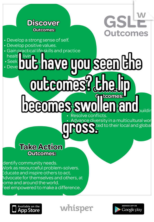 but have you seen the outcomes? the lip becomes swollen and gross. 