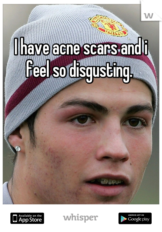 I have acne scars and i feel so disgusting. 