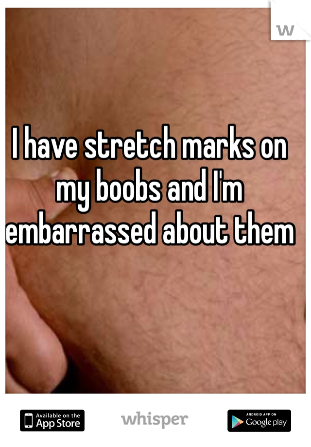 I have stretch marks on my boobs and I'm embarrassed about them
