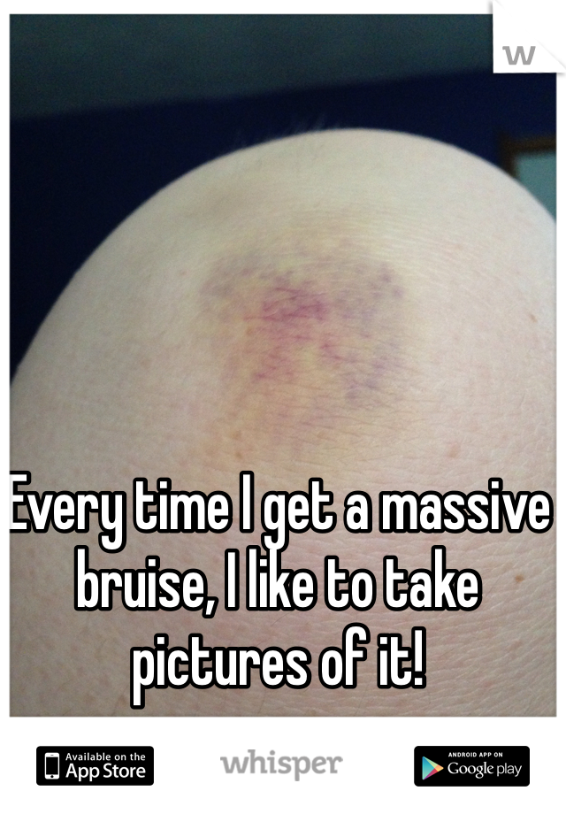 Every time I get a massive bruise, I like to take pictures of it! 