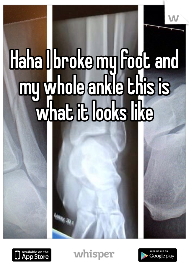 Haha I broke my foot and my whole ankle this is what it looks like 
