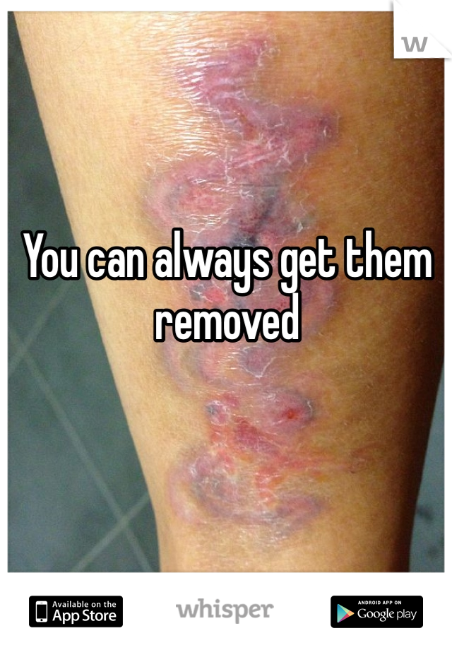 You can always get them removed