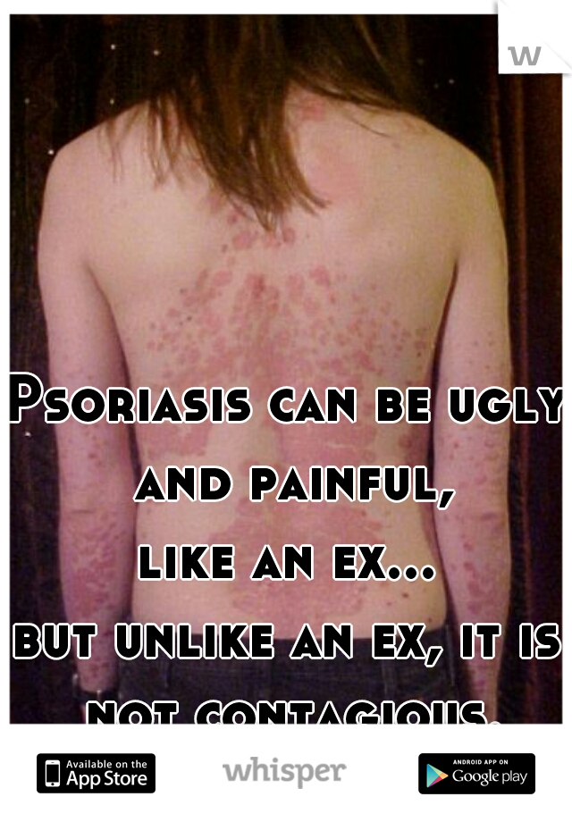 Psoriasis can be ugly and painful,
like an ex...
but unlike an ex, it is not contagious.