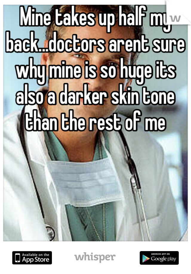 Mine takes up half my back...doctors arent sure why mine is so huge its also a darker skin tone than the rest of me 