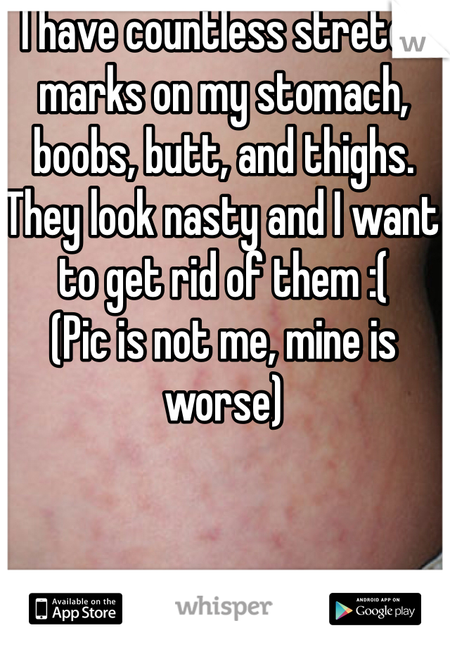 I have countless stretch marks on my stomach, boobs, butt, and thighs. They look nasty and I want to get rid of them :(
(Pic is not me, mine is worse)