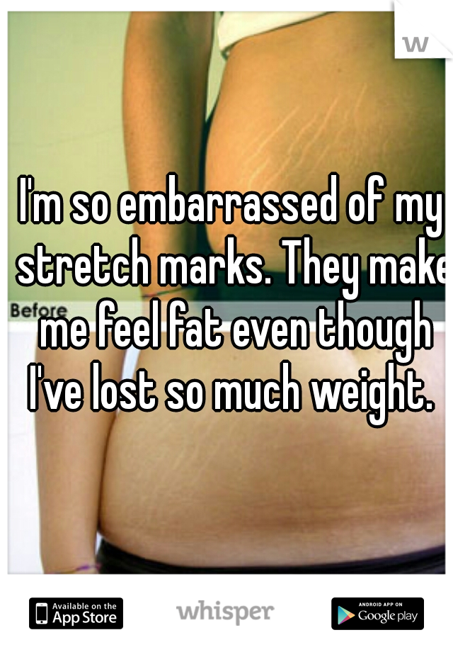I'm so embarrassed of my stretch marks. They make me feel fat even though I've lost so much weight. 