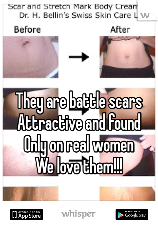 They are battle scars
Attractive and found
Only on real women
We love them!!!
