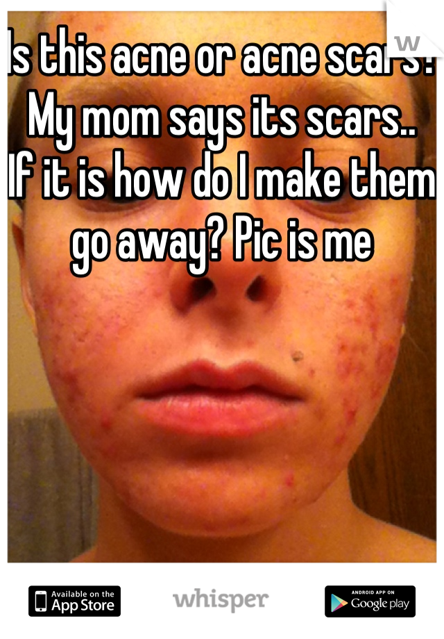 Is this acne or acne scars? My mom says its scars..
If it is how do I make them go away? Pic is me