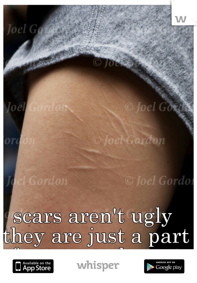 scars aren't ugly they are just a part of your own beauty. 