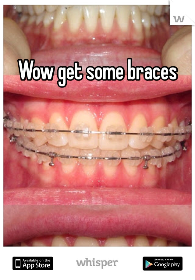 Wow get some braces
