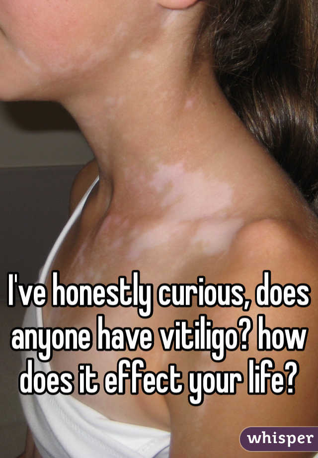 I've honestly curious, does anyone have vitiligo? how does it effect your life?